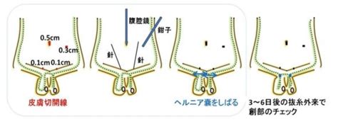 水戸 鼠径部|鼠径ヘルニア（総論）に関連する診療科の水戸市の病院・クリ。